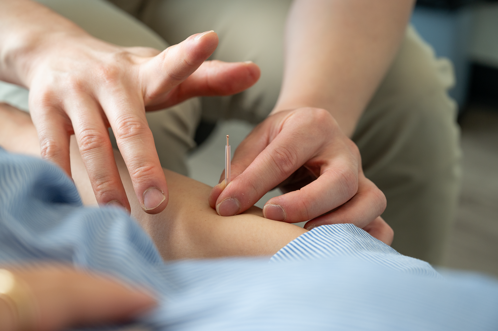 Dry Needling Acupuncture North York