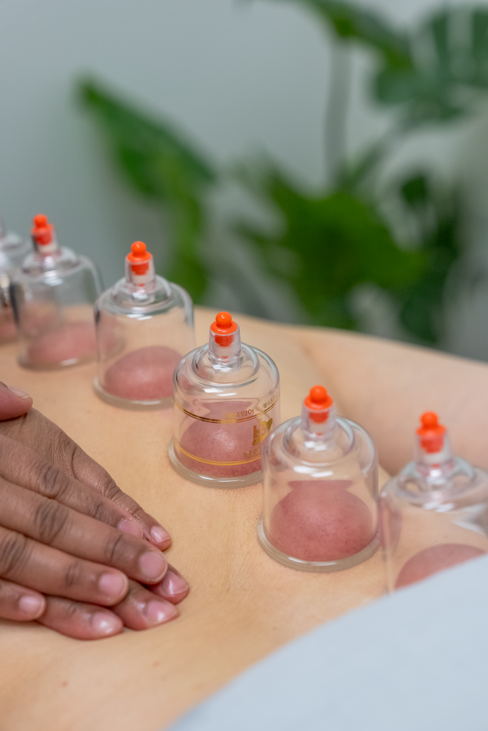 Cupping Therapy North York